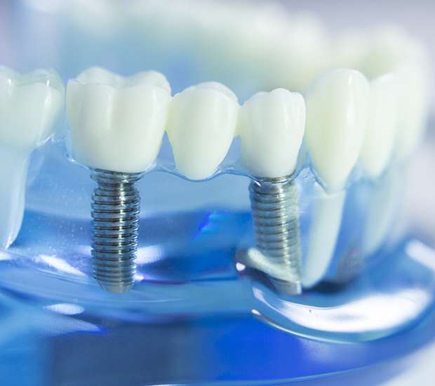 Hialeah Dental Implants